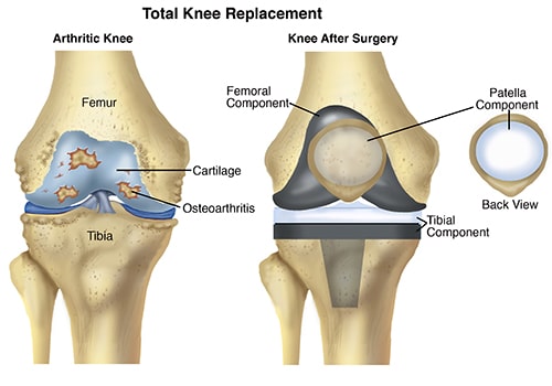 What are the Factors that Influence the Cost of Knee Replacement Surgery?