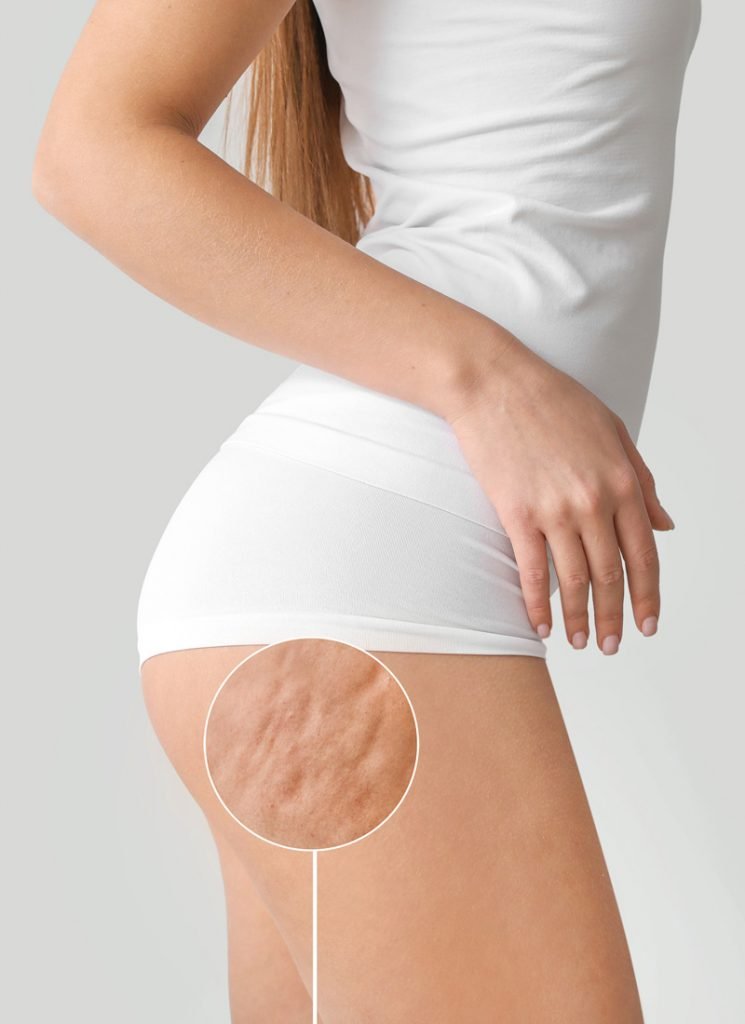 Are There Any Side Effects of Cellulite Treatment in Dubai?